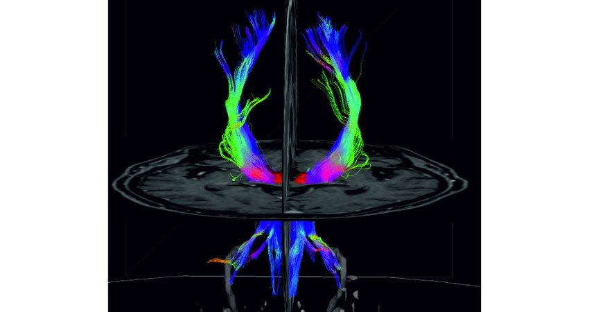 Marco de Estereotaxia