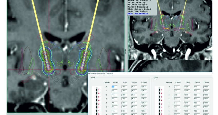 Marco de Estereotaxia